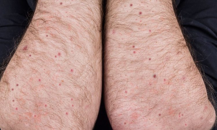 V Nemčiji potrdili prvi primer okužbe z novo različico virusa mpox